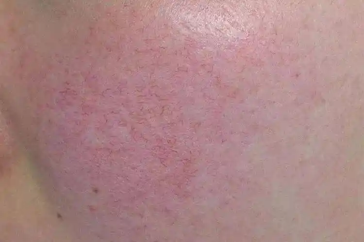 皮肤泛红其实没那么简单