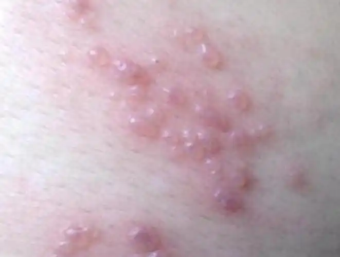 100种皮肤病对照表