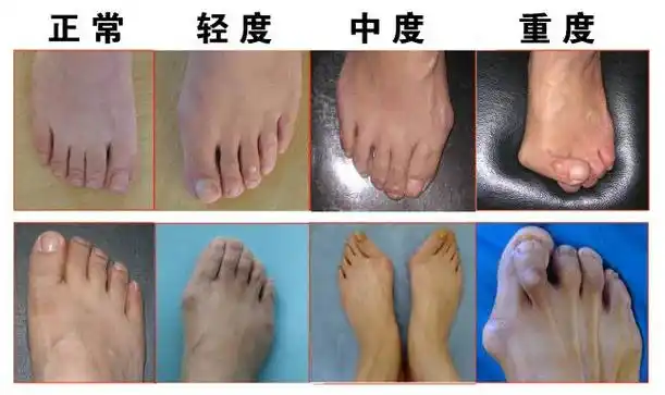 拇外翻发病早期怎么办?拇外翻技术较成熟属哪家