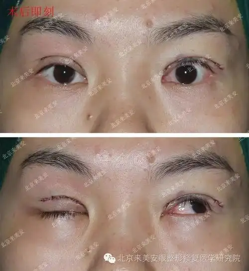 上睑下垂案例2015年8月18日b顾客术前术后1年对比