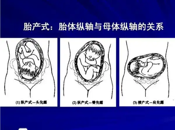 图解胎姿势,胎产式,胎方位,胎先露