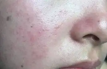 教你敏感肌肤的解决之道_皮肤