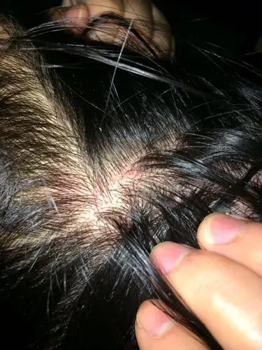 头皮红了还有些疙瘩,是怎么回事?