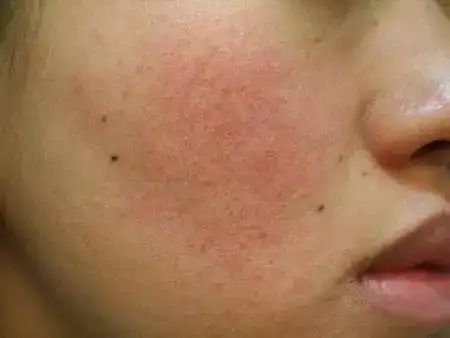 红血丝和敏感肌到底是不是一回事?