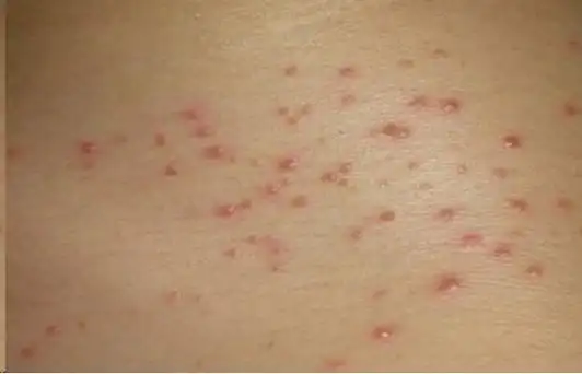 【艾滋病皮肤】艾滋病皮肤症状的特征及治疗