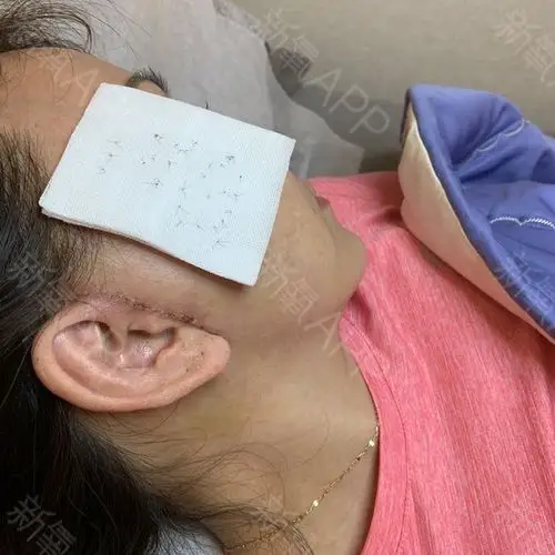 [深圳希思医疗美容医院微创小切口拉皮]