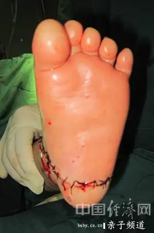 图为:受伤女孩左脚术后照片(胡勇提供)