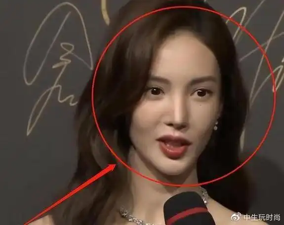 金晨嘴歪成热议话题整容后遗症引发网友疑虑