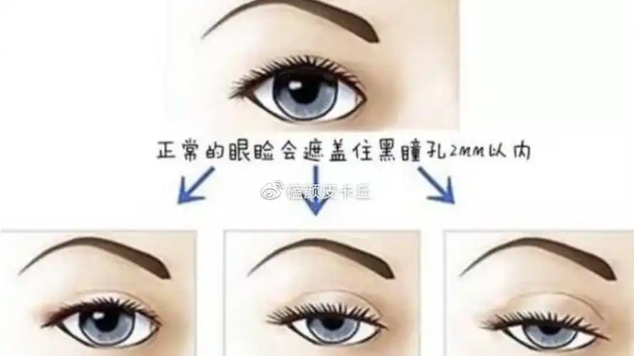 如何判断是否是上眼睑下垂?简单的一张图和一个小动作就可以自行判断