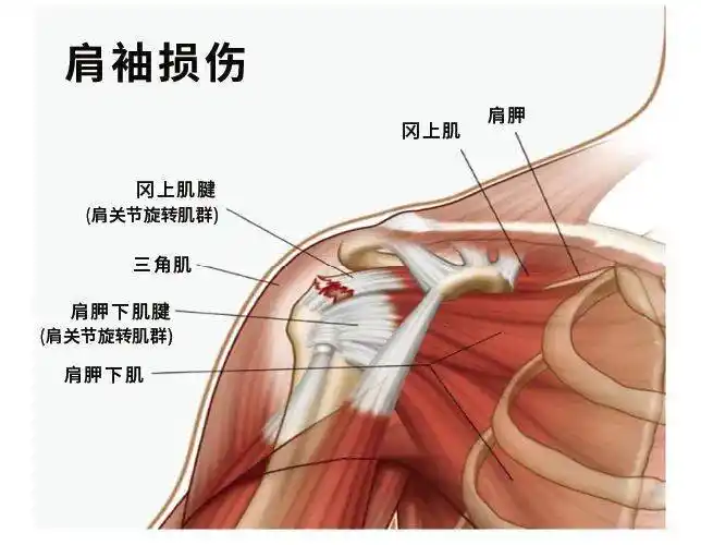 如何预防和改善网球运动带来的肩关节损伤