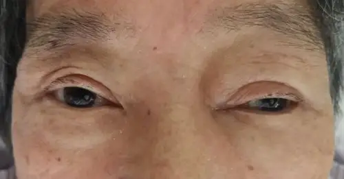 眼睑水肿的罕见元凶