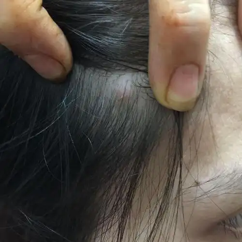 这个包是这几天刚长在头皮上,不痛不痒,摸起来有点点硬.