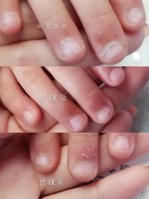 免费全城征集啃指甲的大小宝宝