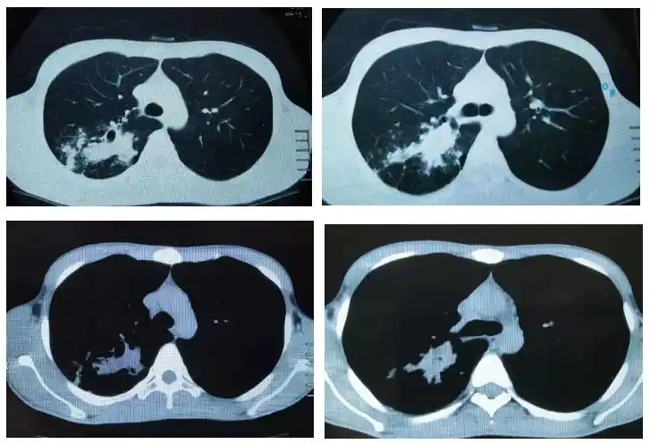 咳嗽咳痰6年小伙吃激素竟吃出肺结核