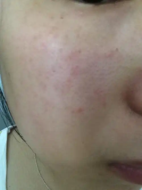 脸上好多年困扰 像痘痘不是痘痘,脸上一层红 医生说角质层薄.