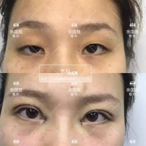 眼综合肌无力案例