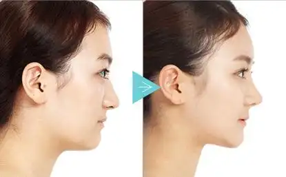 侧脸整形不是简单的垫鼻子