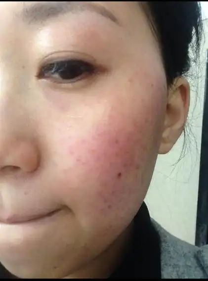 23岁,油性皮肤,毛孔比较大,偶尔也会起痘痘,用哪个牌子的护肤品比较好