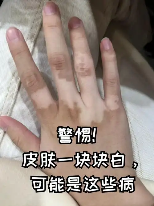 警惕!皮肤一块块白,可能是这些病