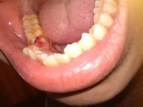 有块肉长到了牙齿上面怎么办?