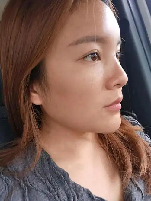 目前恢复的也差不多了,侧脸看起来特别好看,今天没有_圈子-新氧美容