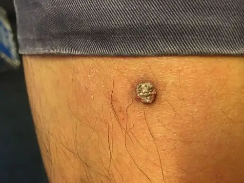 本来像米粒,被我扣破流血后变成黄豆大小,表面凹凸不平有肉刺,这个叫