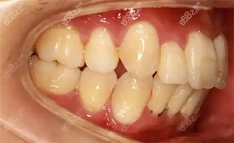 解答龅牙牙齿矫正需要多少钱以及龅牙做矫正是否有用!