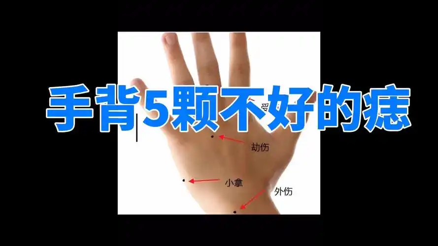 手背5颗不好的痣,千万要点掉!