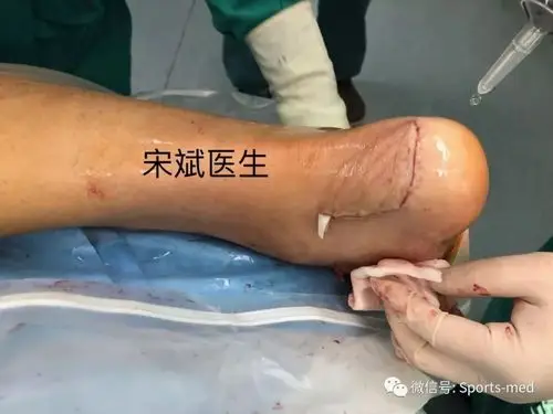 阿喀琉斯之踵的重生之路