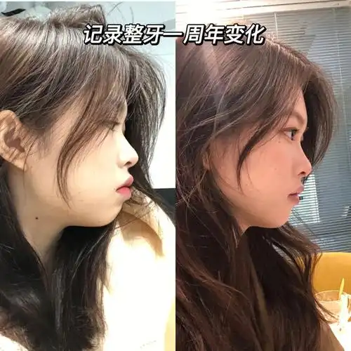 整牙记录牙套一周年变化