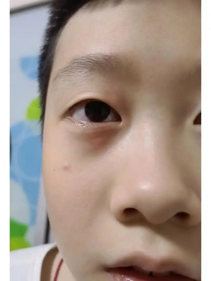 儿子老是眼睛上长疙瘩,还痒,像是过敏的症状,但为什么老是过敏在眼睛