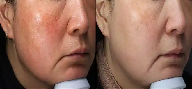 扩散拿什么来拯救你红血丝