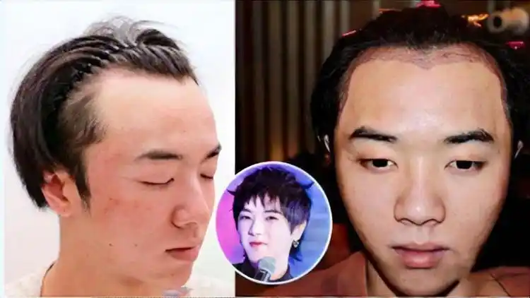 网曝华晨宇秃顶整容,素颜公开不堪入目,满脸痘好似中年油腻大叔_网易