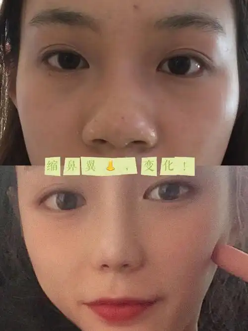 缩鼻翼90sky照片带美颜