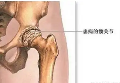 缺血性股骨头坏死症状是怎样的?什么是缺血性股骨头坏死?