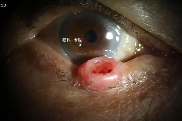 眼皮上长肉球是囊肿还是癌症