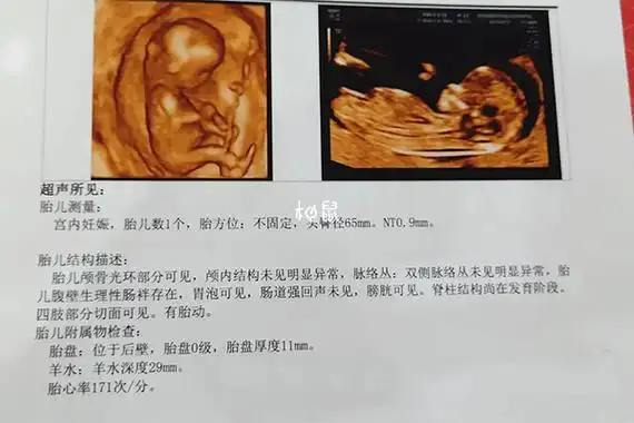 nt检查指的是在孕11-13周做的超声扫描,针对方向是测量胎儿颈部后方皮