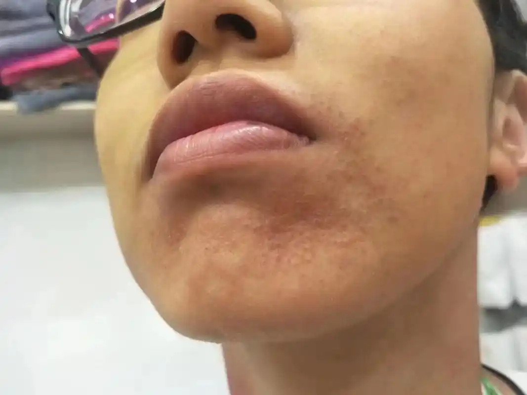 敏感肌的,激素脸的,皮肤反反复复过敏的,调到自己快放弃的看过 - 抖音