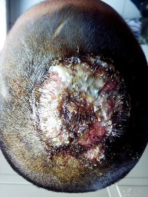 【病例讨论】这个头皮是肿么回事?请教园内大侠指点 [病例帖]