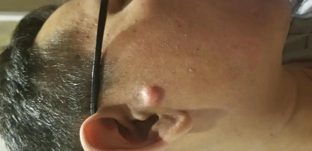 请教图片中耳前皮下肿物可能是什么