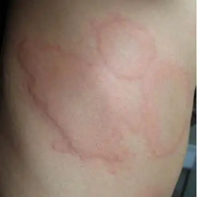 过敏性荨麻疹图片39
