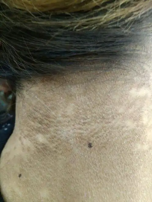 脖子上起的黑黑的,不痛不痒的,这是什么皮肤病