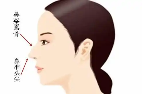 鼻梁露骨 鼻准头尖