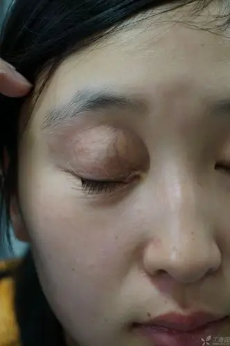【病例讨论】单侧眼睑皮肤萎缩 [病例帖]