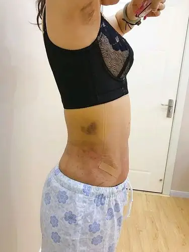 吸脂完之后,我最喜欢的事情是拍点现在的照片,我是想看看最后我恢复完