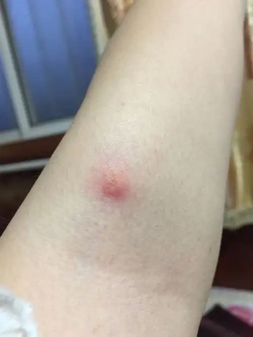 前天腿上起了两个蚊子叮的包,下午后背也起了几个,昨天胳膊肘长了好几