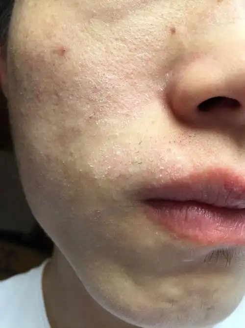 脸上干,脱屑,一直不见好,是不是什么皮肤病?