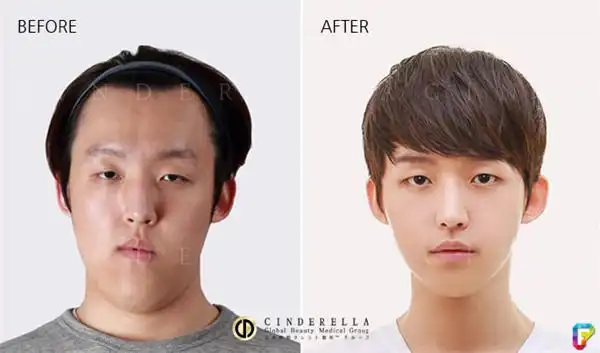 15张韩国整容对比图原本看完女生的已经超震撼,结果看到男生的才发现