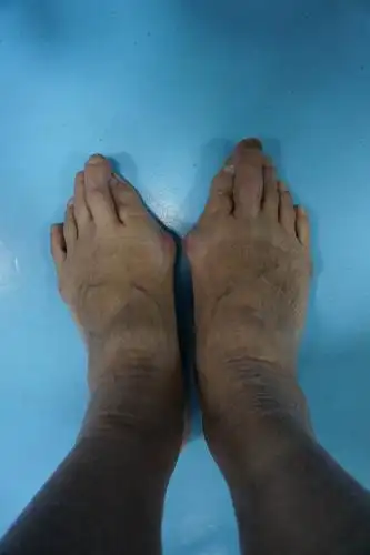 广济手足外科医院近期病例分享之:拇外翻