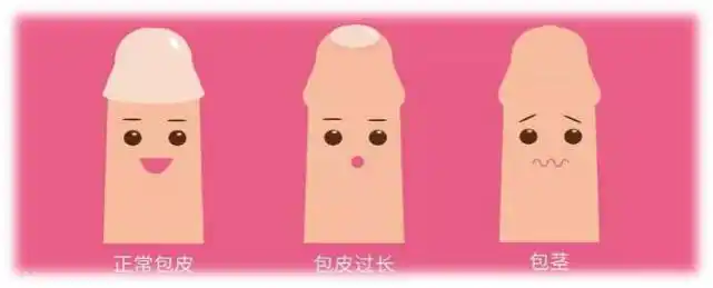 医聊| 李医生:儿童包茎是正常现象吗?